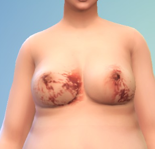 Bruised Breast